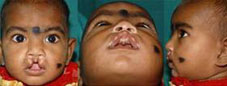 Type I a Symmetrical cleft involving vermillion and white roll of lip but not involving nostrils
