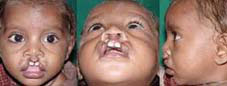 Type I b Symmetrical cleft involving vermillion and white roll of lip and also involving nostrils