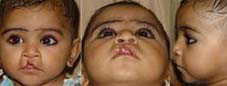 Type II a Asymmetrical cleft involving vermillion and white roll of lip but not involving nostrils.