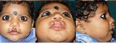 Type II b Asymmetrical cleft involving vermillion and white roll of lip and also involving nostrils.