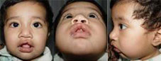 Type I Submucous cleft