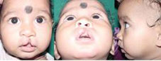 Type IV Extending beyond whiteroll involving the nose