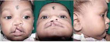 Type IV Extending beyond whiteroll involving the nose