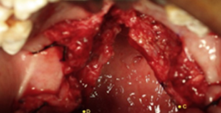  Closure of nasal layer with  Levator Myoplasty