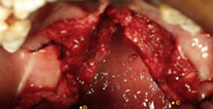 Closure of nasal layer with Levator Myoplasty
