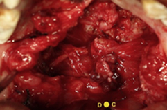 Closure of nasal layer with Levator Myoplasty