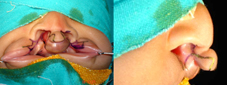 Afroze Incision of transverse nasalis muscle.