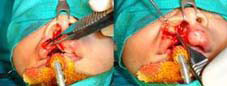 Minimal muscle dissection ensuring dissection.