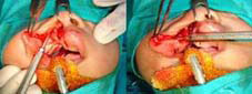 Wide sub-periosteal dissection from the vestibule on the cleft side is done to relieveall muscle attachments from around thepiriform rim, ala, lateral surface of nose,infraorbital and malar area.