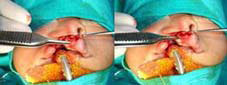 Minimal muscle dissection is done on the non-cleft; side relieving all abnormal attachments on anterior nasal spine and columella.