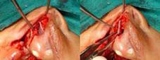 SEPTUM IS KEY All attachments to the septum are relieved reduceand the septum is positioned in the fistulae.anatomical center.