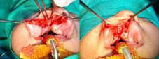  Periosteoplasty is done to exert more medial pressure on the palatal shelves and to the occurrence of anterior palatal.
