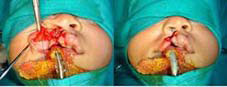 Ala of nose stabilized symmetrically to match that of the normal side