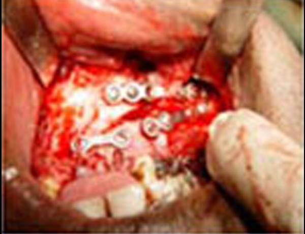 Bone Plate Fixation
