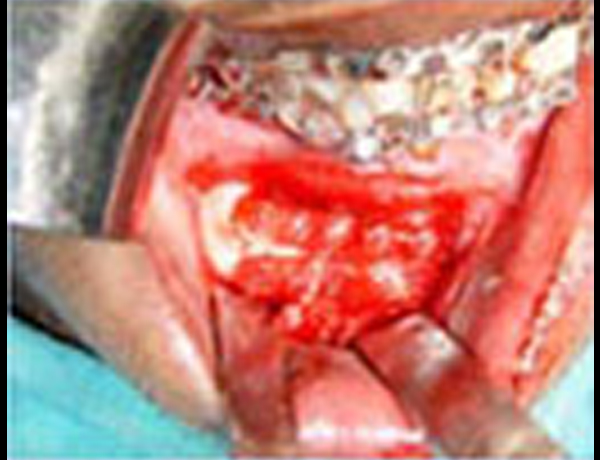 Bio Resorbable Bone Plates