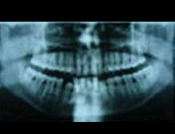 Intraop X-Ray