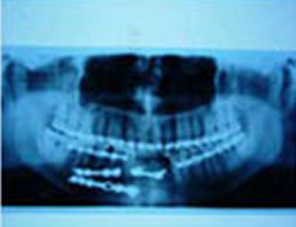 Postop X-Ray