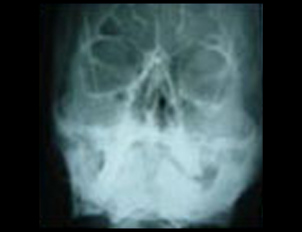 Preop X-Ray