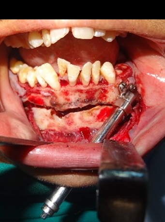 Intraop