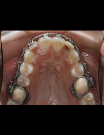 Ongoing Ortho Treatment